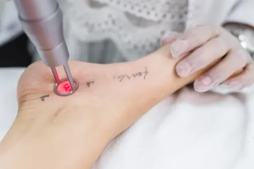 Eliminación de tatuajes con láser