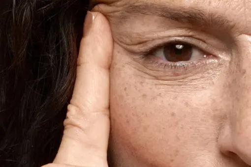 Lifting de párpado con láser